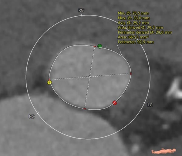 Interdisciplinary therapeutic strategy in a low-risk patient with aortic stenosis and preserved life expectancy - Figure 1