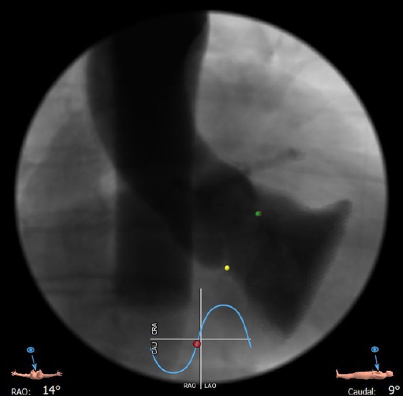 Interdisciplinary therapeutic strategy in a low-risk patient with aortic stenosis and preserved life expectancy - Figure 10