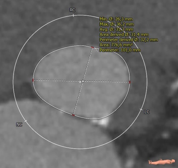 Interdisciplinary therapeutic strategy in a low-risk patient with aortic stenosis and preserved life expectancy - Figure 2
