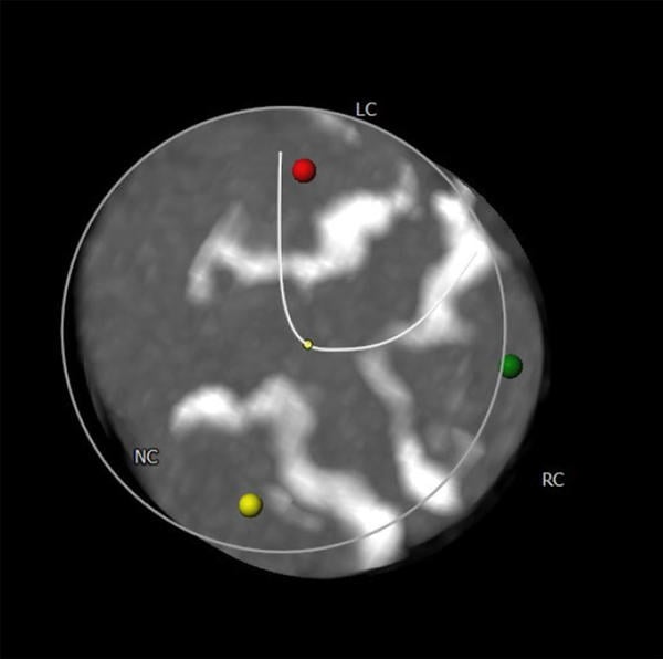 Interdisciplinary therapeutic strategy in a low-risk patient with aortic stenosis and preserved life expectancy - Figure 3
