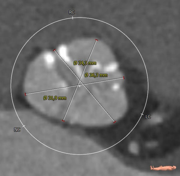 Interdisciplinary therapeutic strategy in a low-risk patient with aortic stenosis and preserved life expectancy - Figure 4