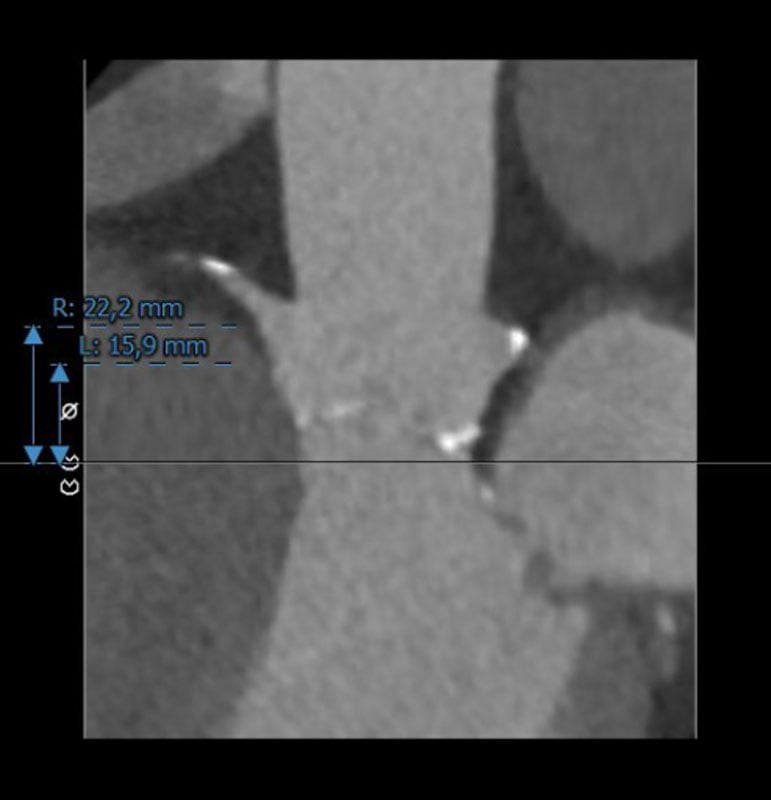 Interdisciplinary therapeutic strategy in a low-risk patient with aortic stenosis and preserved life expectancy - Figure 5