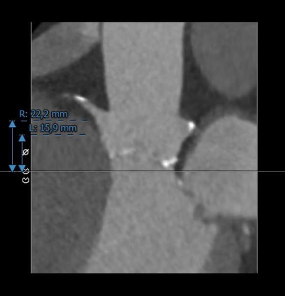 Interdisciplinary therapeutic strategy in a low-risk patient with aortic stenosis and preserved life expectancy - Figure 5