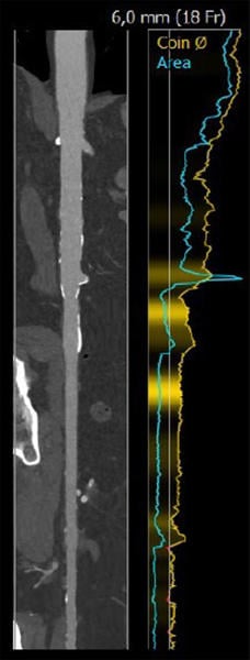 Interdisziplinäre Therapiestrategie bei einem Patienten mit geringem Risiko, Aortenstenose und erhaltener Lebenserwartung - Abbildung 6