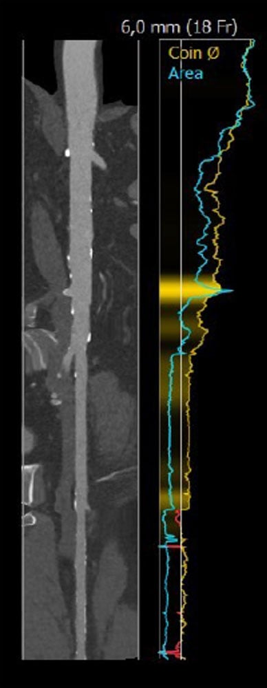 Interdisciplinary therapeutic strategy in a low-risk patient with aortic stenosis and preserved life expectancy - Figure 7