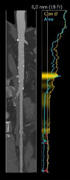 Interdisciplinary therapeutic strategy in a low-risk patient with aortic stenosis and preserved life expectancy - Figure 7