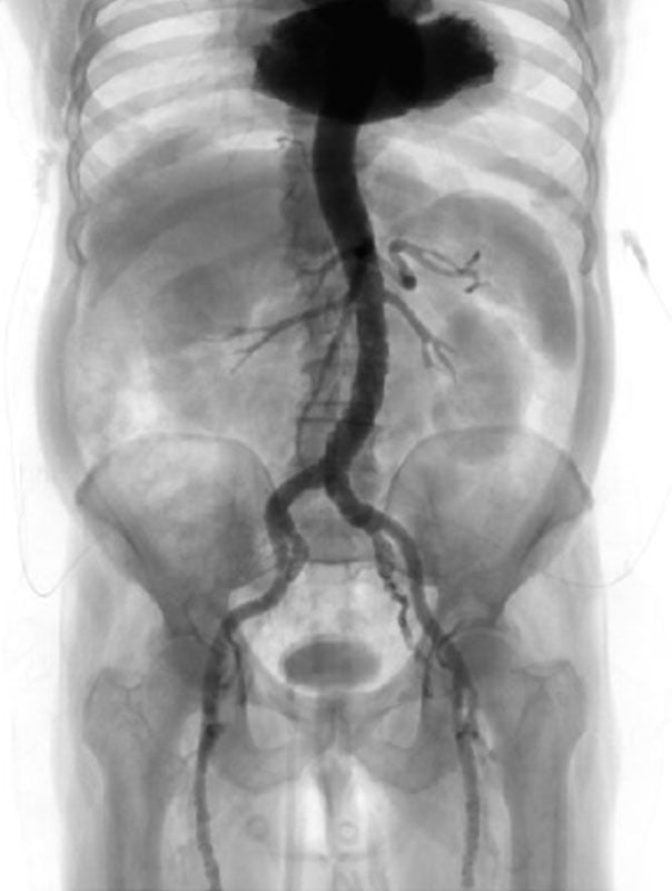 Interdisciplinary therapeutic strategy in a low-risk patient with aortic stenosis and preserved life expectancy - Figure 8