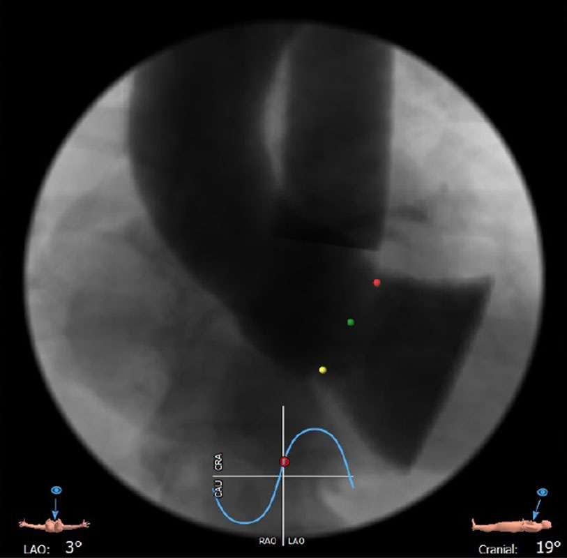 Interdisciplinary therapeutic strategy in a low-risk patient with aortic stenosis and preserved life expectancy - Figure 9
