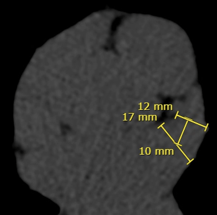 Ostium 17 mm, landing zone 12 mm