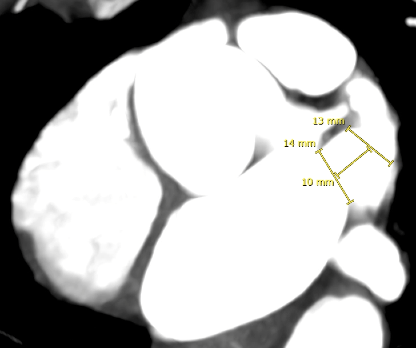 Min/max diameter: 11/13 mm - Average diameter: 12 mm