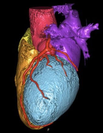 Very-small-LAA-with-a-challenging-closure-figure5