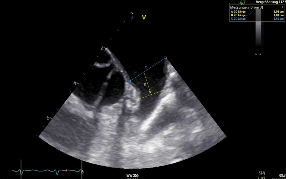 Very-small-LAA-with-a-challenging-closure-figure7