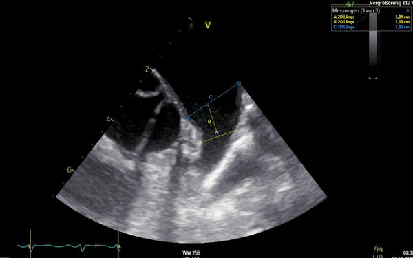 Very-small-LAA-with-a-challenging-closure-figure7