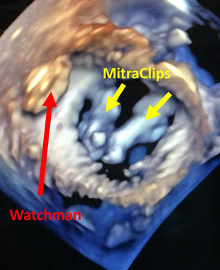 Thickened myxomatous mitral valve