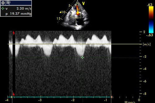 Immediate post procedural result