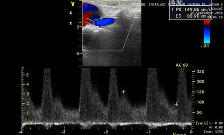 A longitudinal image of a distal left radial artery pseudoaneurysm and corresponding spectral Doppler waveform from the communicating jet