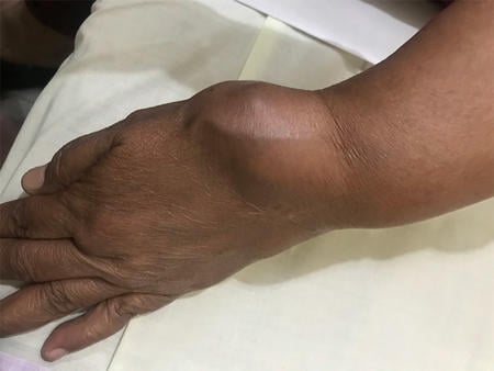 Gradually increasing swelling at the puncture site of left distal radial artery