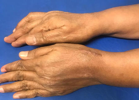 Patient’s left hand after pseudoaneurysm operation