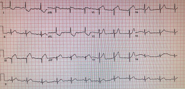 ECG at presentation