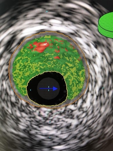 Optional IVUS
