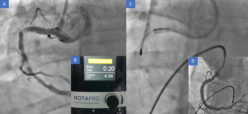 Rocky RCA - Extensive calcified lesion on LAD