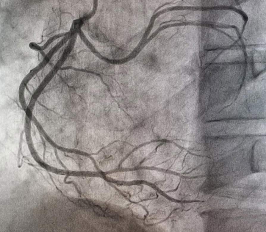 The coronary angiography revealed left system LAD and Ramus without lesions, RCA no lesions and anomalous origin of the circumflex coronary artery from the proximal segment of the RCA without lesions