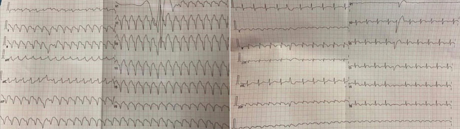 The electrocardiogram after cardioversion documented a inferior STEMI