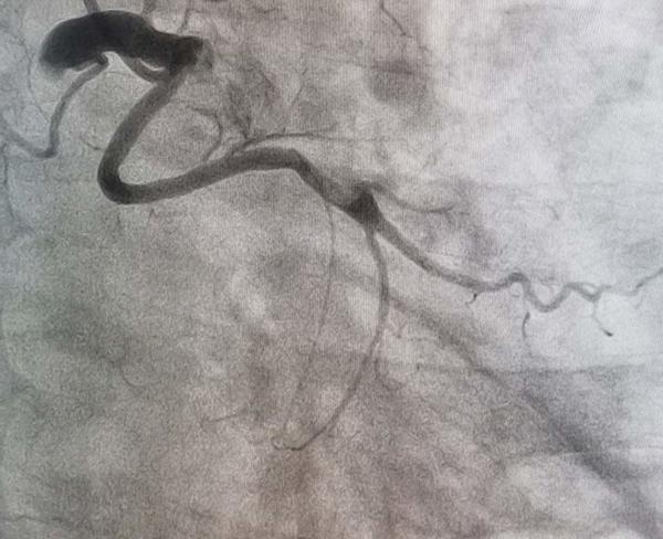 The coronary angiogram revealed left system without lesions, ectatic RCA with acute total occlusion in the middle segment with grade 5 thrombus, and anomalous origin of the circumflex coronary artery arising from the proximal segment of the RCA with fusiform aneurysm in its middle portion