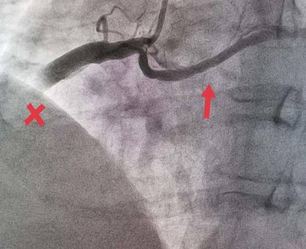 The coronary angiogram revealed left system without lesions, ectatic RCA with acute total occlusion in the middle segment with grade 5 thrombus, and anomalous origin of the circumflex coronary artery arising from the proximal segment of the RCA with fusiform aneurysm in its middle portion 