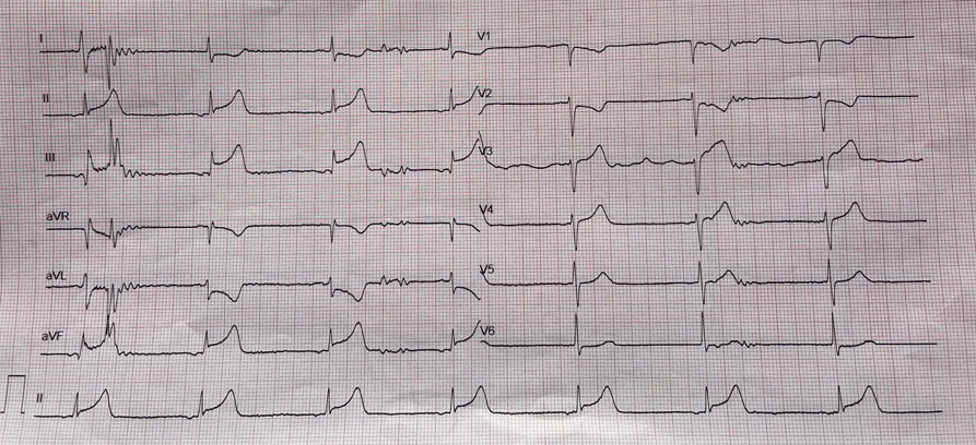 Figure 1: a 80-year-old gentleman, with history of hypertension, dyslipidemia and former smoker, admitted to our center because of inferior STEMI, two hours after symptom onset 