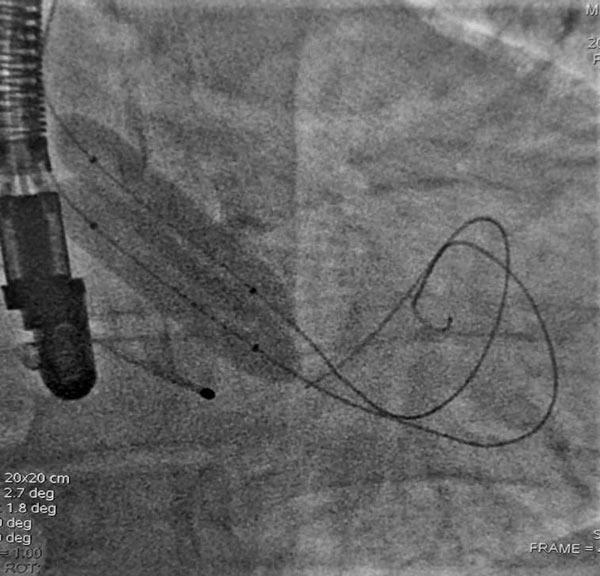 Figure 2 – Bilateral distal radial aortic valvuloplasty with simultaneous balloons (double 12x40 mm 7F compatible balloons, VACS II Osypka AG, Germany).