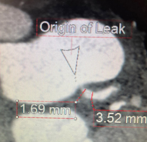 Origin of Leak