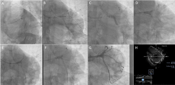 Summary of the staged procedure Left Main PCI.  A. Left Circumflex rotational atherectomy