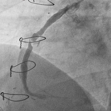 Figure 1: Severe lesion in a large 15 year old SVG to the RCA