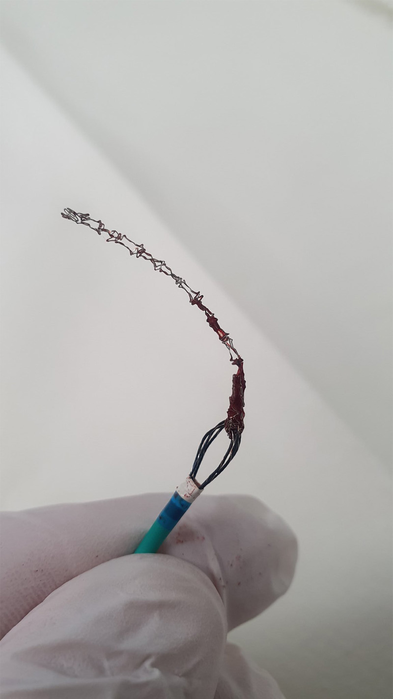 Migration of the stent in the left main stem due to poor lesion preparation - Figure 1