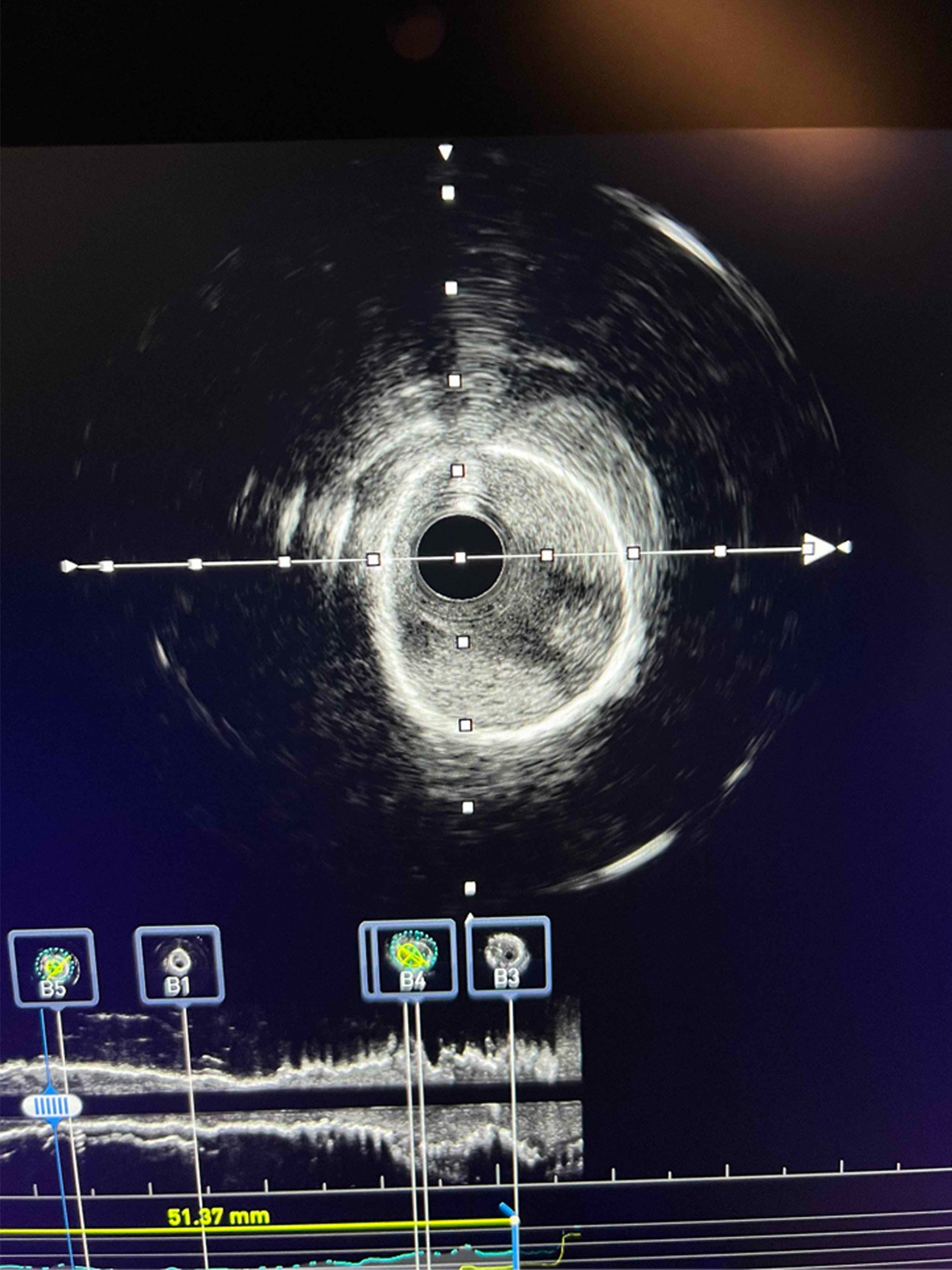PCI for in-stent restenosis complicated by neoatherosclerosis dissection - figure 1
