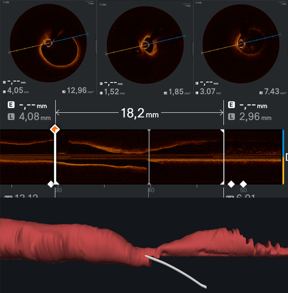 Stepwise OCT for treatment optimization in provisional approach of bifurcated coronary lesions - Figure 1