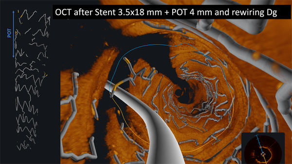 OCT after Stent 3.5x18 mm + POT 4 mm and rewiring Dg