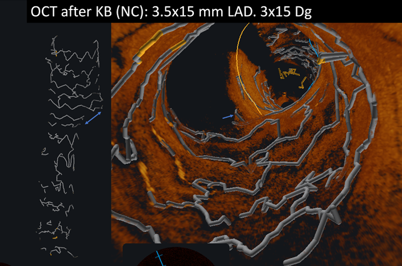 OCT after KB (NC): 3.5x15 mm LAD. 3x15 Dg