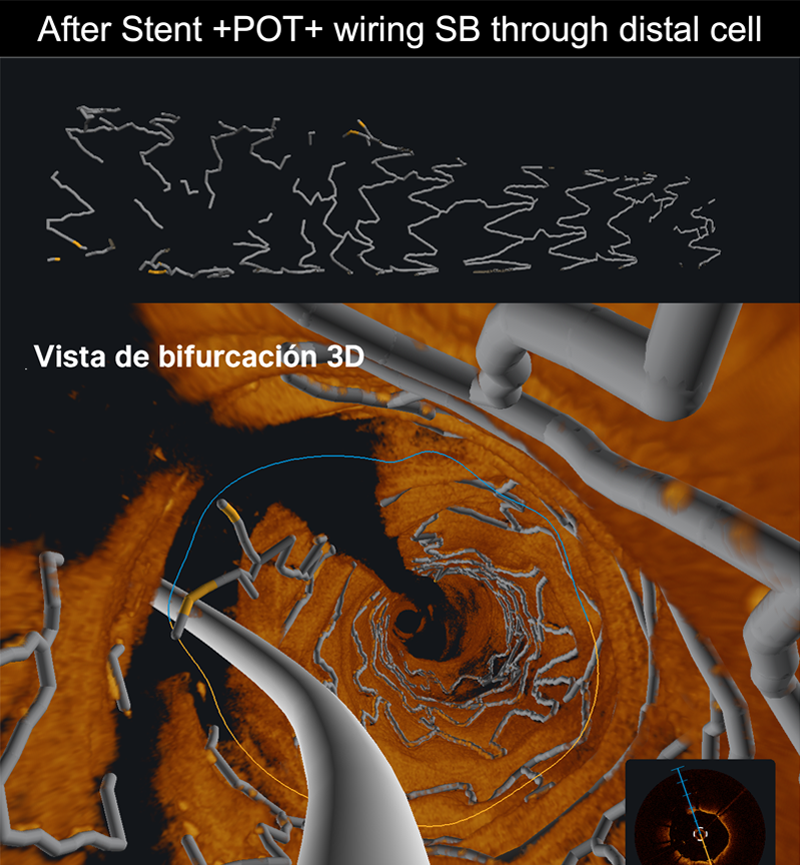 After Stent +POT+ wiring SB through distal cell