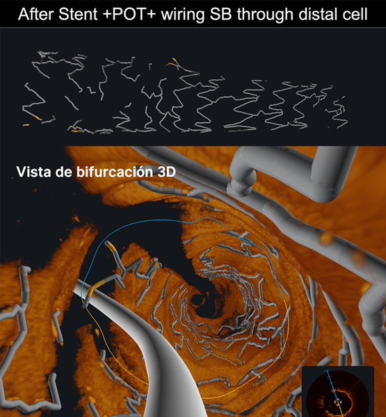 After Stent +POT+ wiring SB through distal cell