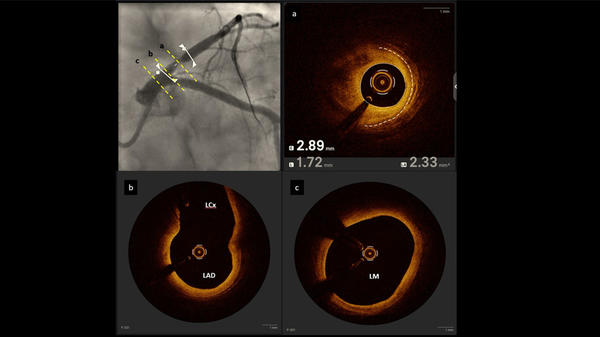 Precision PCI in the ERA of AI and multimodality imaging - Figure 2