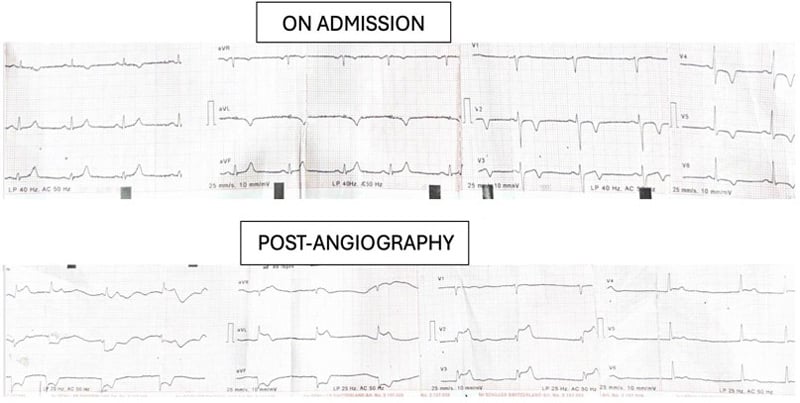 Coronary calcification versus thrombus: ECG done on admission and that done post-Angiograpghy showing significant changes on comparison to the baseline.