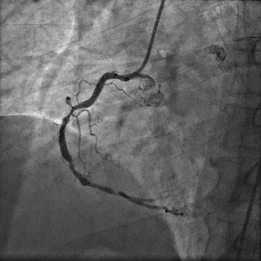 Coronary calcification versus thrombus: Dominant vessel with extensive calcification and significant stenotic disease involving the proximal, mid, and distal segments