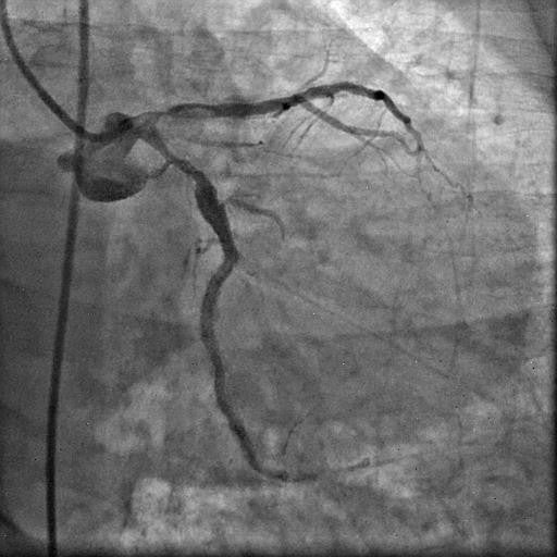Coronary calcification versus thrombus: short, bifurcating left main (LM) with heavily calcified LAD and LCx with patent previously placed stents
