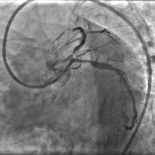 Coronary calcification versus thrombus: Check Angiogram demonstrating Thrombus embolization.