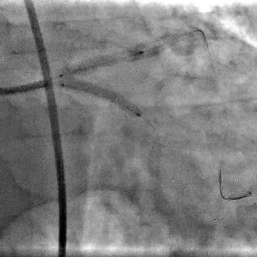 Coronary calcification versus thrombus: Simultaneous stenting from the left main to the LAD and LCx (3.0 × 24 mm Promus Elite stents) using the simultaneous kissing stent (SKS) technique after lesion preparation using a cutting balloon.