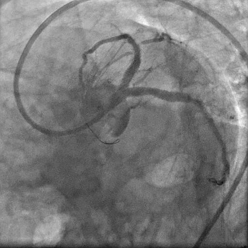 Coronary calcification versus thrombus: Final Check Injection following post dilatation showing TIMI III flow across the vessels.