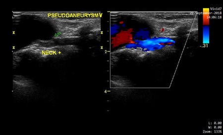 A longitudinal image of the distal left radial artery shows a defect in the anterior wall following catheter access