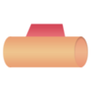 Type I coronary perforation